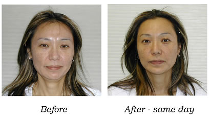 before and after acupuncture facial treatment before and after acupuncture facial treatment